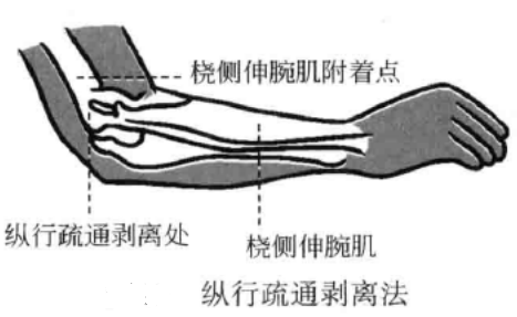 小针刀的运刀方法