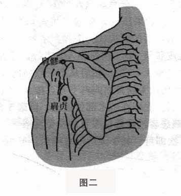 肩周炎钩针疗法