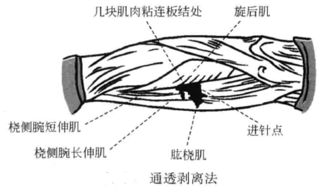 小针刀的运刀方法
