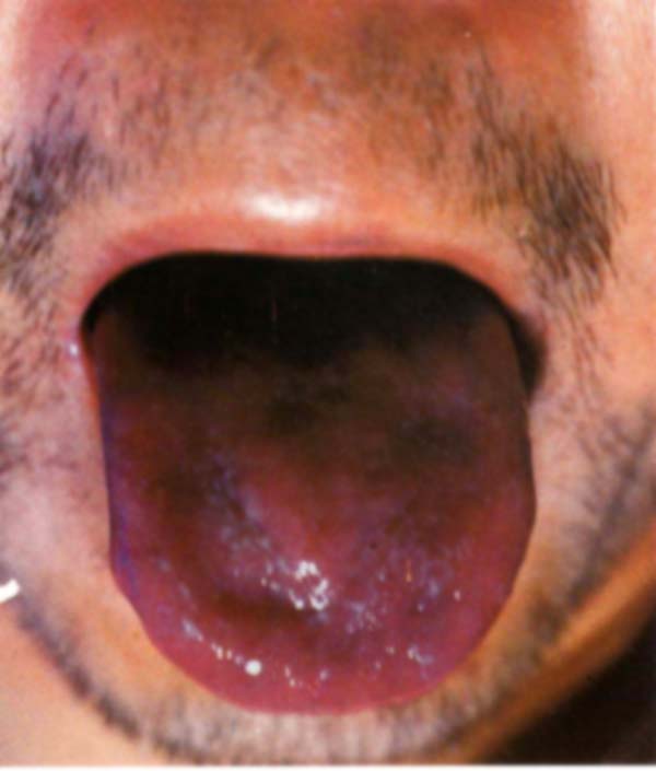 绛紫凸凹舌光剥苔