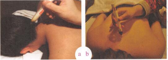 瘰疬艾灸哪个部位图解