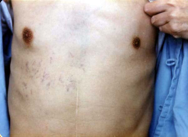 中医望肢体之扁平胸