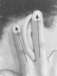 腰椎间盘突出症按摩部位图解