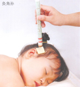 流行性腮腺炎艾灸哪个部位图解