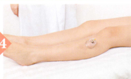 痢疾拔罐部位图解