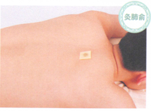 慢性支气管炎艾灸哪个部位图解