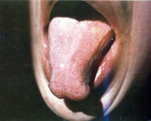 淡红舌偏白滑苔2