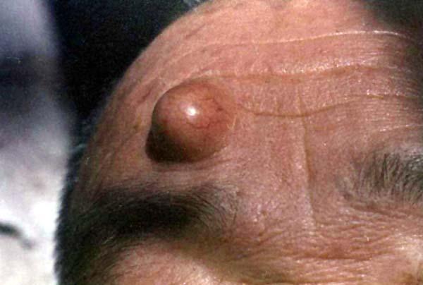 中医望皮肤之瘤赘