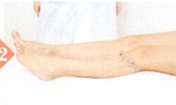 脚气拔罐部位图解