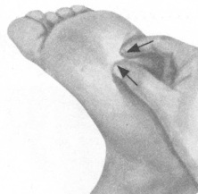 腰椎间盘突出症按摩部位图解