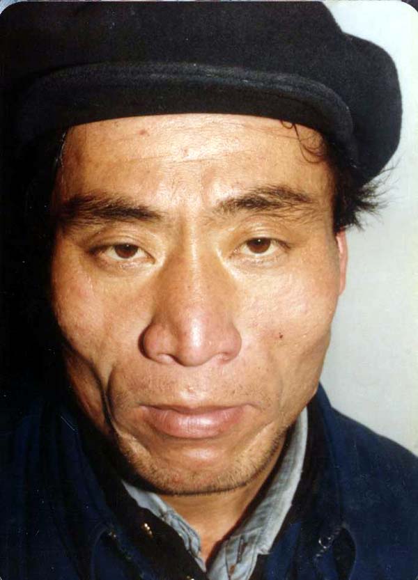 中医望鼻之准头红黄