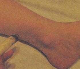 防治青春痘艾灸哪个部位图解