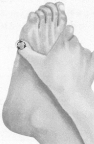 风湿病按摩部位图解