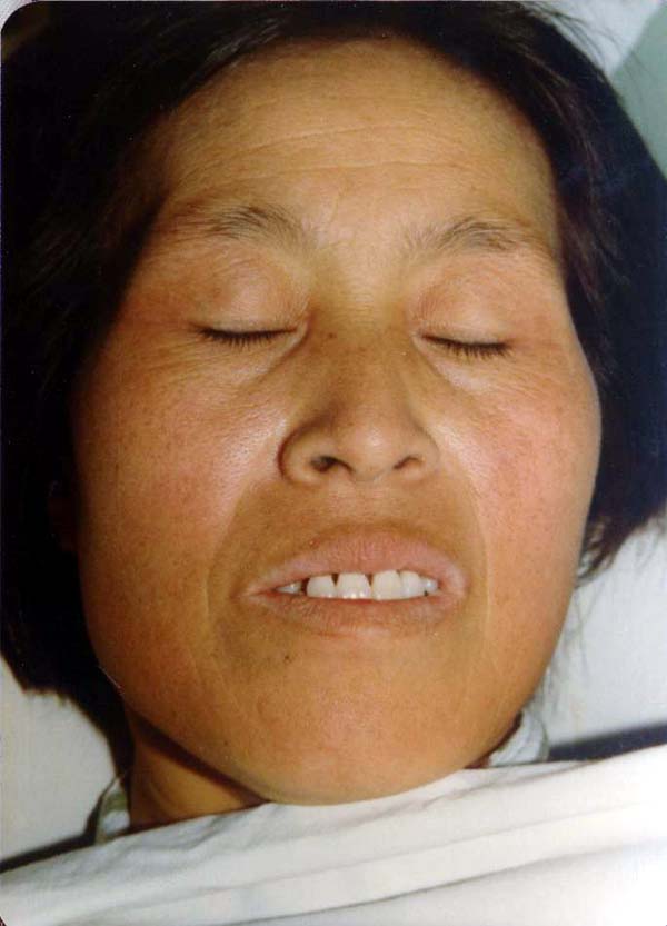 中医望色之青黄