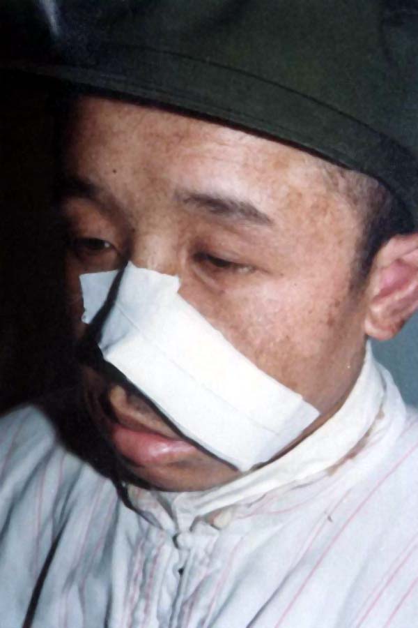 中医望鼻之鼻柱塌陷