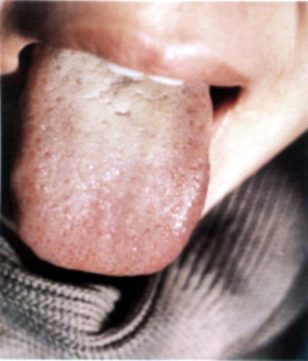 淡红舌红点舌半截黄腻苔