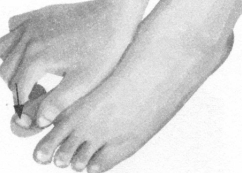 鼻炎按摩部位图解