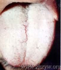 淡红舌白积粉苔