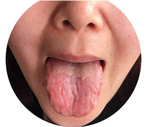 几种异常舌苔预示疾病