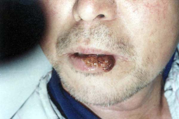 中医望口与唇之茧唇