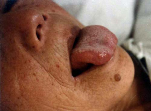 中医望皮肤之扁平疣1