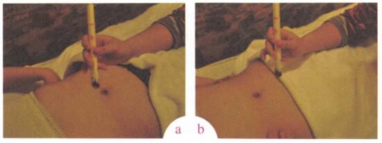 消除黑眼圈艾灸哪个部位图解