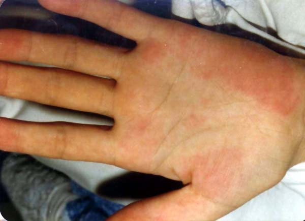 中医望肢体之肝掌