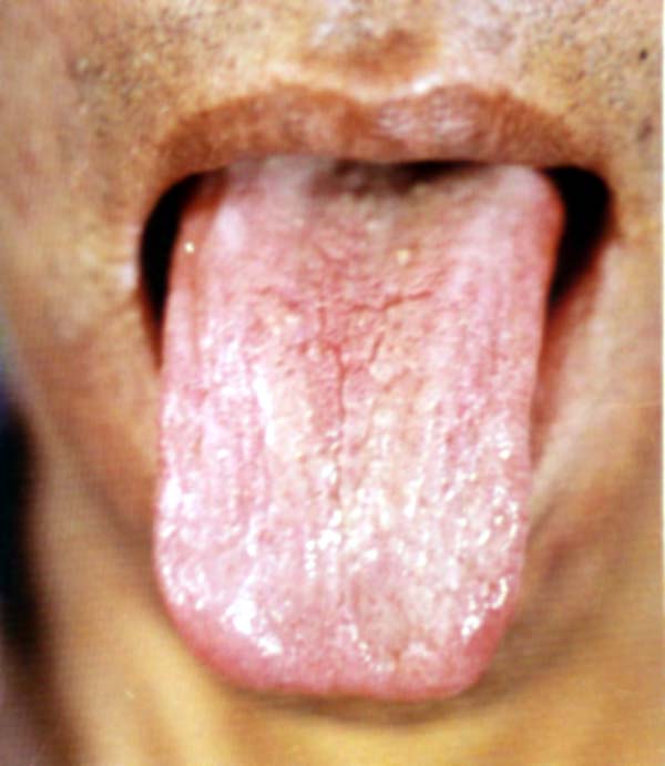 淡红瘦薄舌双黄苔