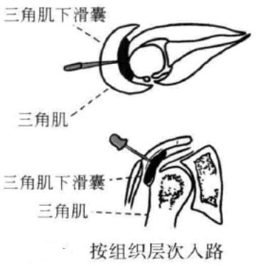 小针刀操作手术入路