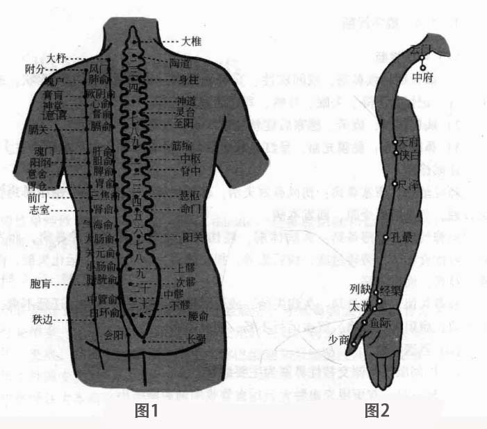 慢性单纯性鼻炎磁圆梅针疗法
