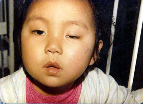 中医望神之虚证少神2