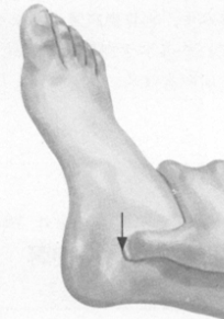 风湿病按摩部位图解