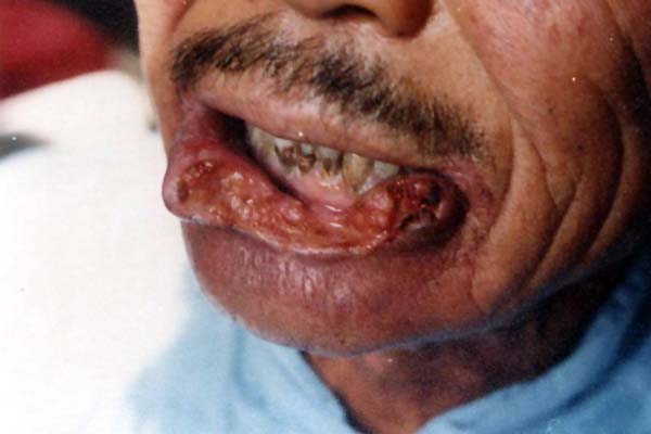 中医望口与唇之茧唇溃蚀