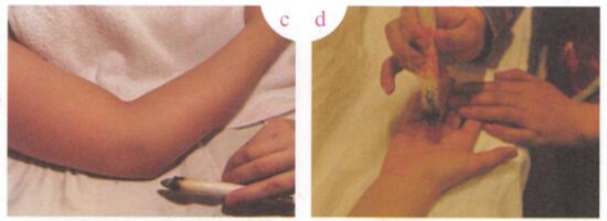 瘰疬艾灸哪个部位图解