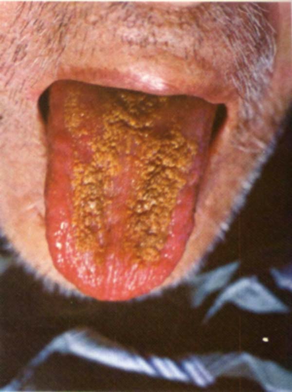 红绛瘦薄舌黄瓣浮垢苔