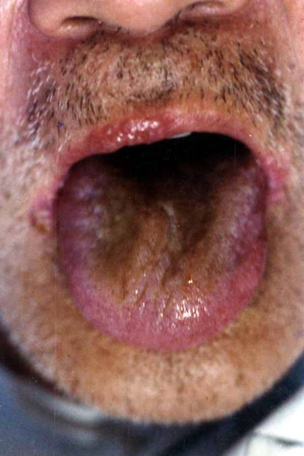 中医望口与唇之口唇疱疹