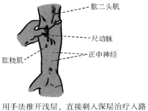 小针刀操作手术入路