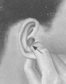 肥胖症按摩部位图解