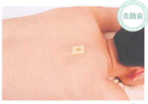 哮喘艾灸哪个部位图解