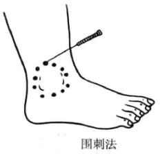 火针疗法的进针方法