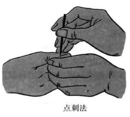 三棱针的操作方法