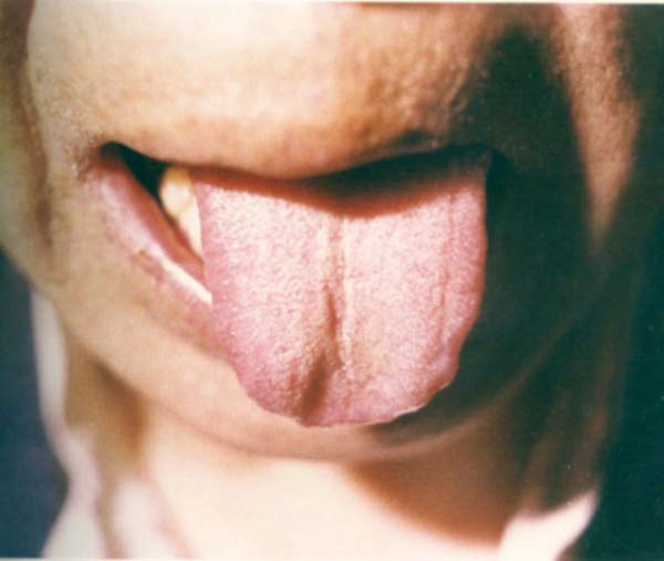 淡红舌尖黄根白苔