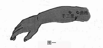 网球肘钩针疗法