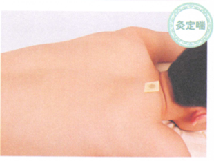 慢性支气管炎艾灸哪个部位图解