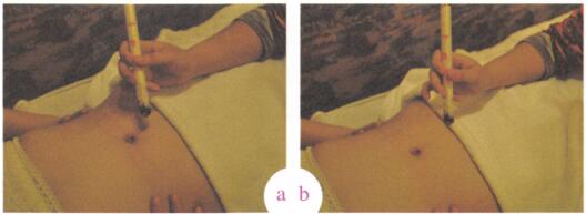 卵巢囊肿艾灸哪个部位图解