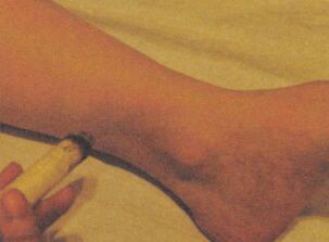 消除眼袋艾灸哪个部位图解