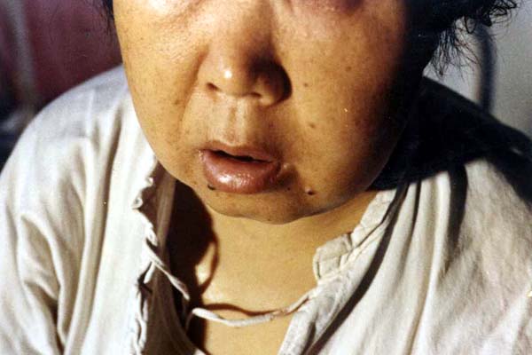 中医望色之面肿唇肿