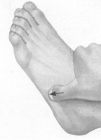 风湿病按摩部位图解