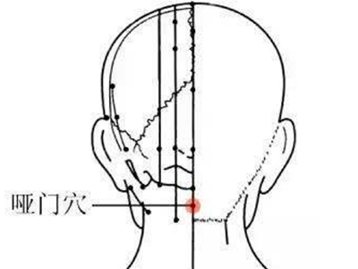以哑门、扶突、环跳穴为主穴，针刺治疗中风后遗症