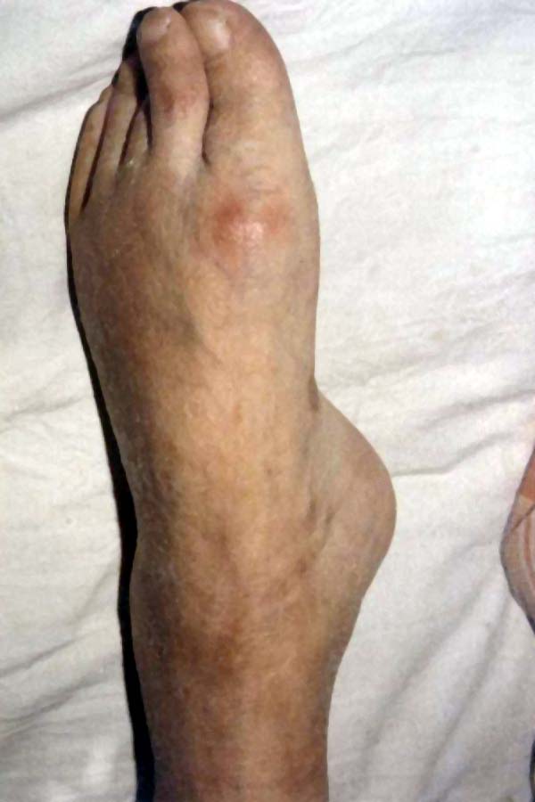 中医望肢体之趾关节炎